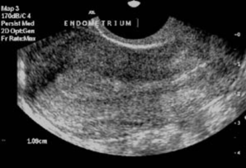 <ul><li><p>Thick, uniformly hyperechoic central band</p></li><li><p>All 3 layers mentioned in late proliferative phase are all hyperechoic</p></li><li><p>Maximum thickness of <u>8-15 mm</u></p></li></ul><p></p>