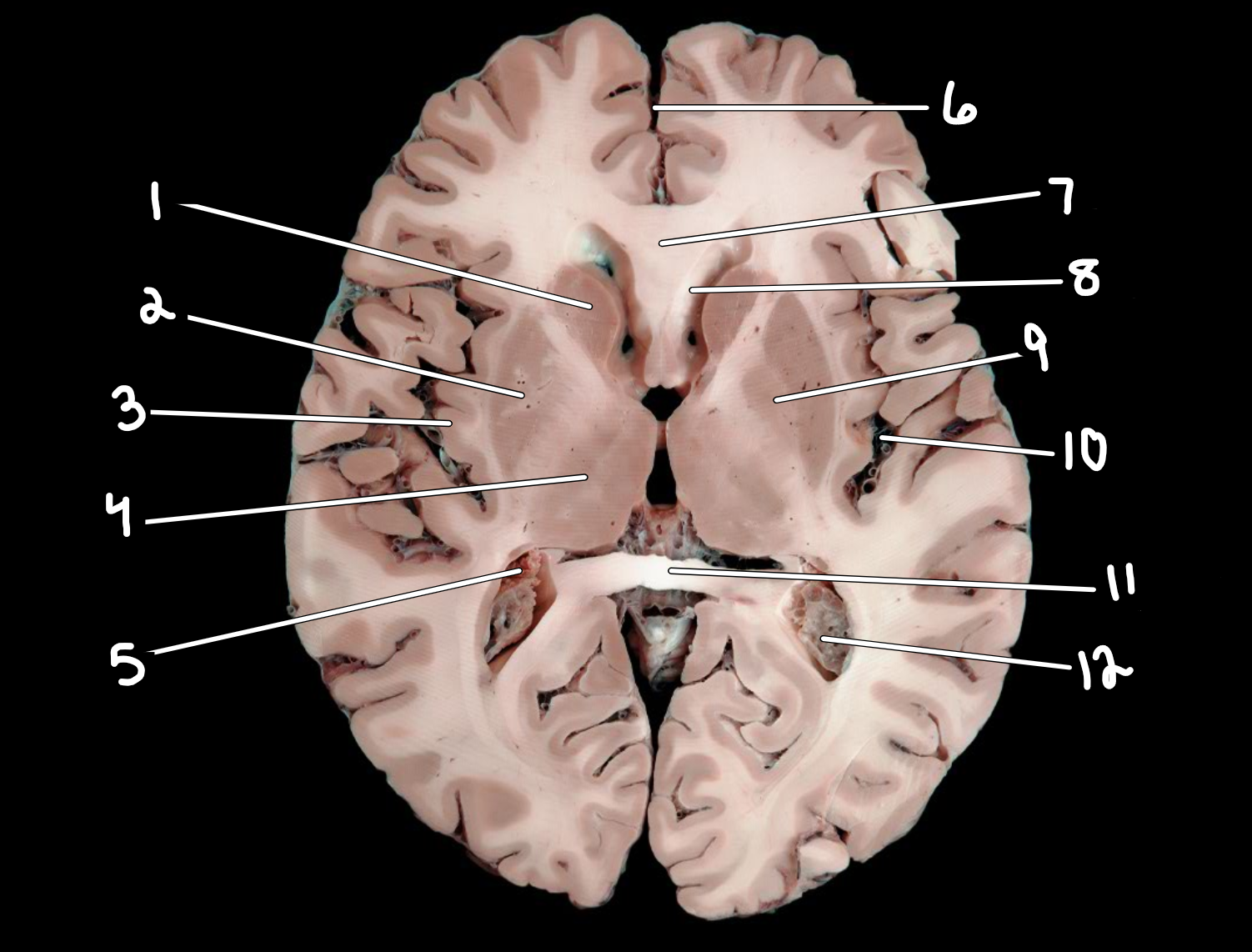 <p>Brain: transverse section </p>