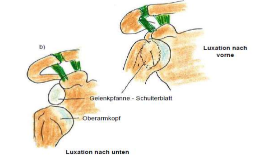 <p>Schulterluxation</p><p></p><p></p>