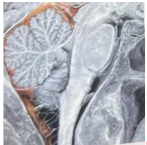 <p><strong>The highlighted space above represents</strong></p><p>a. The third ventricle</p><p>b. epidural space</p><p>c. the 4th ventricle</p><p>d. subarachnoid space</p><p>e. cerebral aqueduct</p>