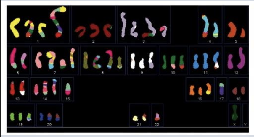 <p>Based on this figure and your prior knowledge from the course, which of the following do you conclude:</p><p></p><p>A) The majority of human genomic DNA encodes biologically important information that cannot be disrupted in living cells </p><p>B) This cancer is caused by a mutation inherited from the patient’s parent </p><p>C) In the pancreatic cancer shown here, gene expression levels could be influenced by chromosome loss, translocation, and duplication </p><p>D) Only genetic changes occurring in regions of DNA that encode proteins are relevant to tumor progression</p>
