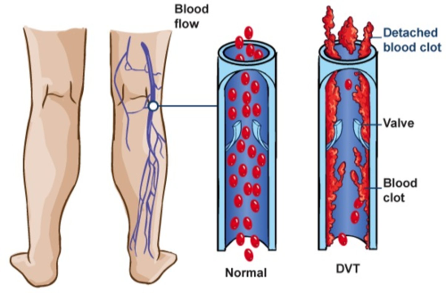 <p>Blood clots in the superficial or deep veins</p>