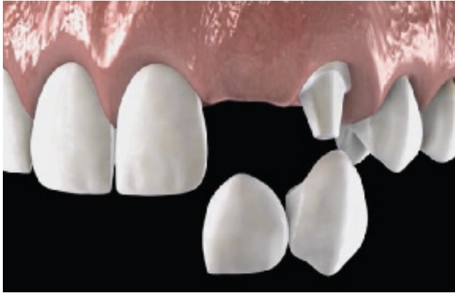 <p>where only one side of the pontic is attached to one or multiple retainers </p>