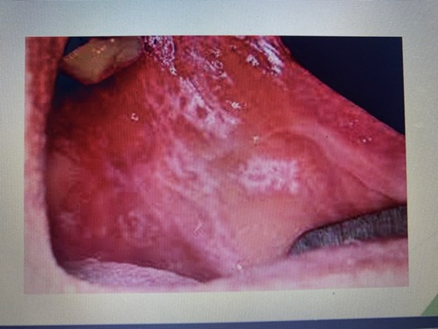 <p>This lesion is most common in middle aged adults with a slightly higher occurrence in women.</p><p>Can be characterized by Wickhams Striae.</p><p>Most commonly seen on the cheeks but may be seen on the tongue, lips, floor of mouth, and Gingiva.</p>