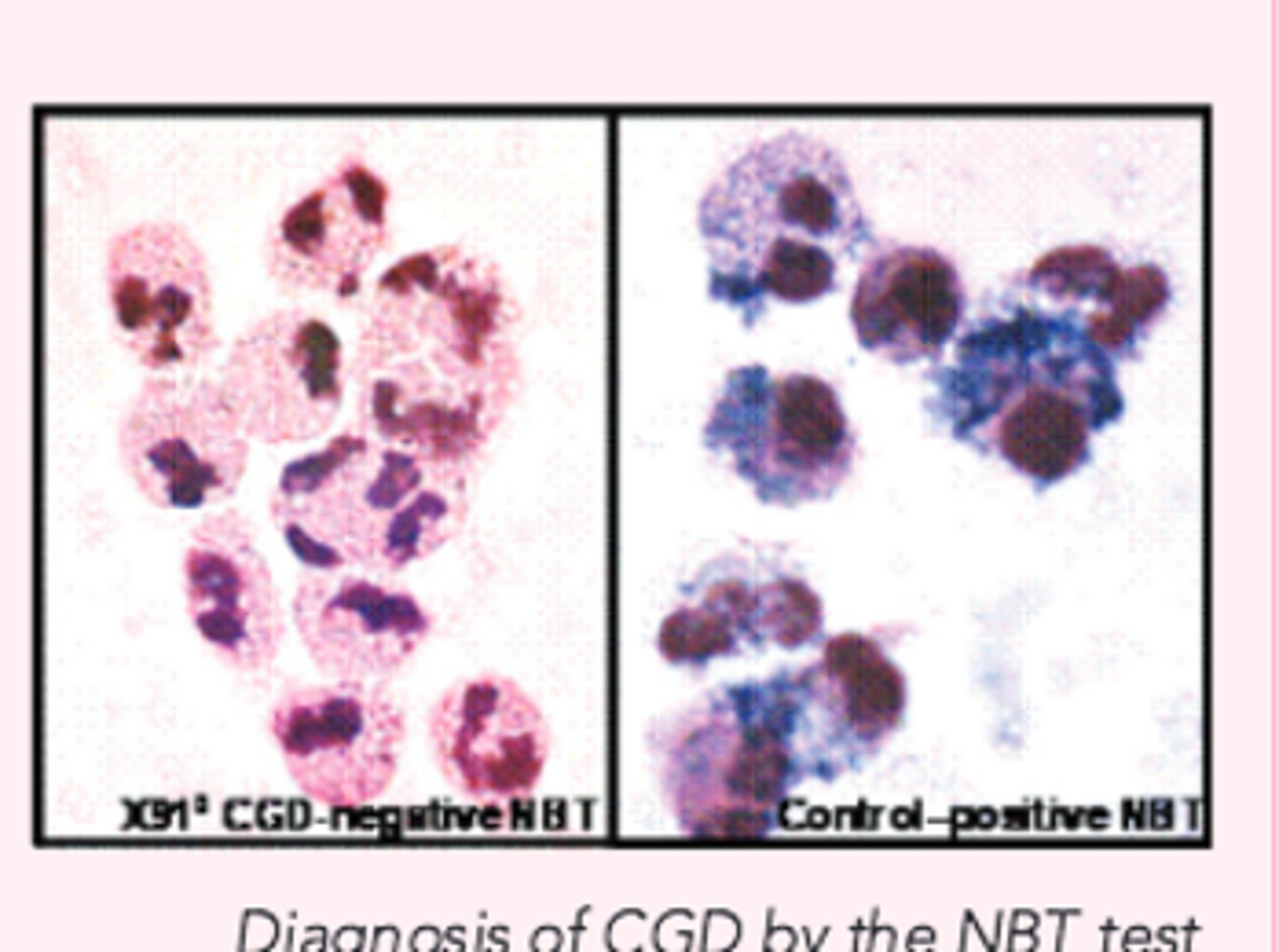 <p>Reduced to a blue insoluble formazanpigment by O2 generated by activatednormal phagocytes (qualitative)</p>