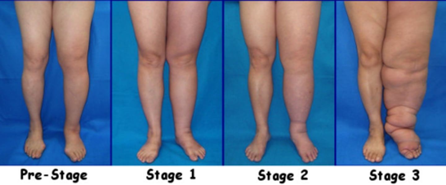 <p>Sub-clinical: lymph transport impaired, no obvious signs/symptoms, can last for years</p>
