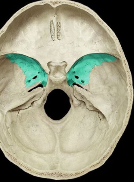 <p>greater wing of sphenoid</p>