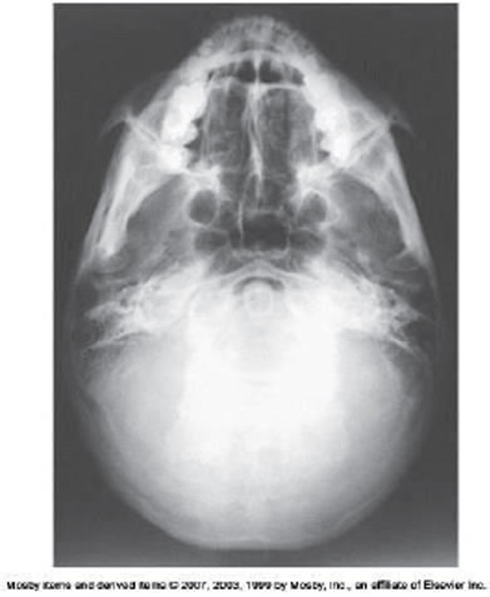 <p>a. Perpendicular to IOML</p>