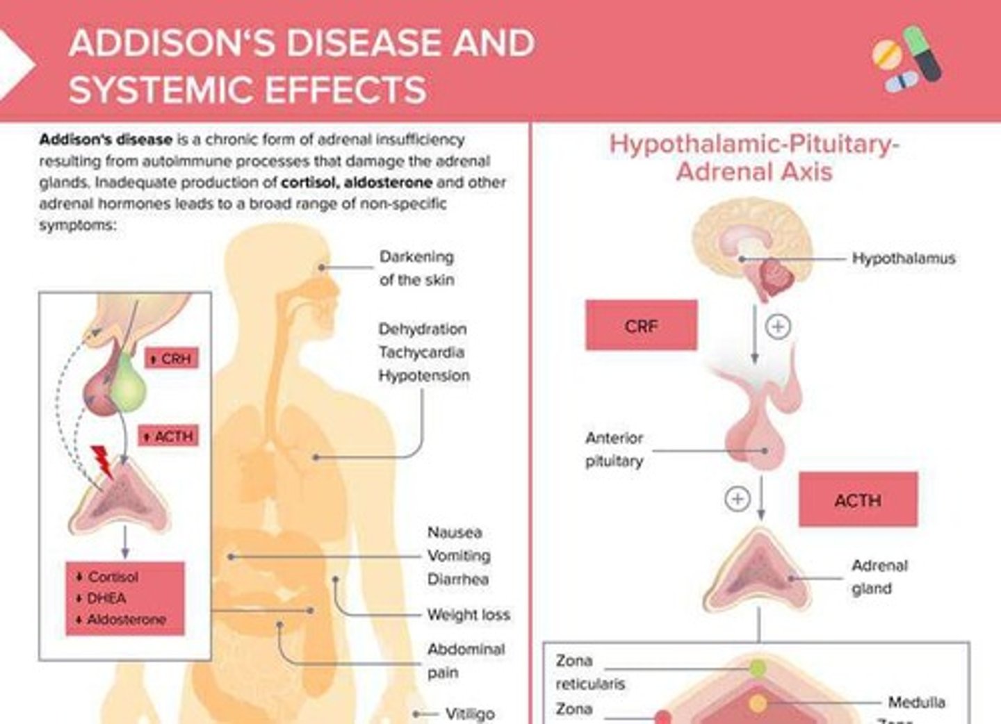 <p>Adrenal insufficiency, or hypoadrenalism, is a condition characterized by low levels of cortisol and aldosterone, leading to impaired stress response.</p>