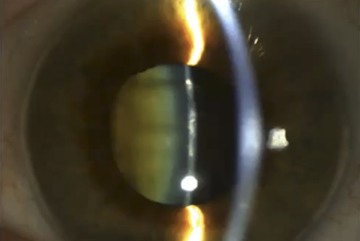 <ul><li><p>Magnification: 16X </p></li><li><p>Beam Height: 6 mm, just be bigger than pupil</p></li><li><p>Beam Width: 4-6 mm</p></li><li><p>Filter: OUT</p></li><li><p>Angle: 20-30 </p></li></ul><p></p>