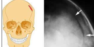 <p>What type of fracture is this? </p>