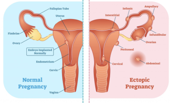 <ul><li><p><strong>EFFECT </strong></p><ul><li><p>Oocyte is fertilized in peritoneal cavity or distal uterine tube and begins developing there </p></li><li><p>Normally abort naturally with substantial bleeding</p></li></ul></li></ul><p></p>