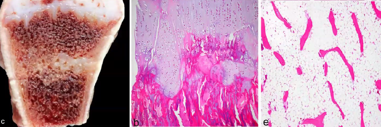<p>What is the condition?</p><p>A-Osteoporosis</p><p>B-Osteopetrosis</p><p>C-Rickets</p><p>D-Chondrodysplasia</p>