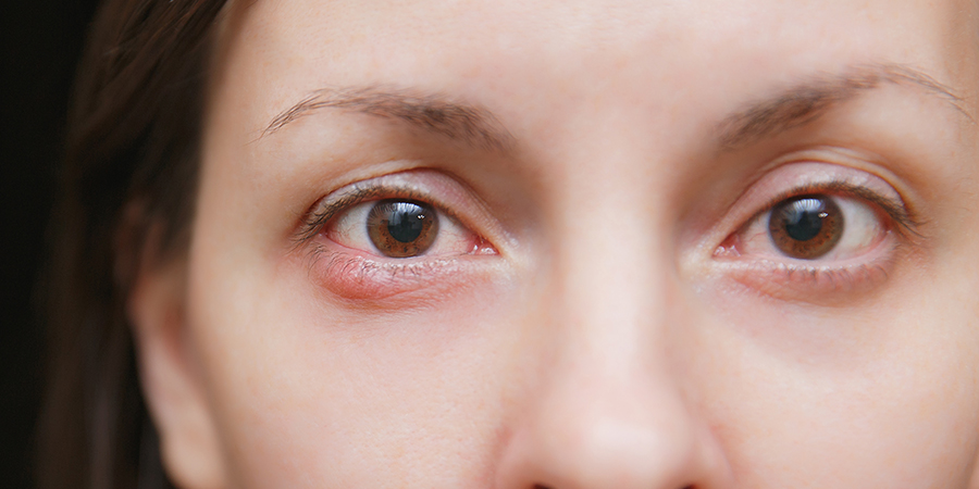 <p>Infected meibomian gland</p>