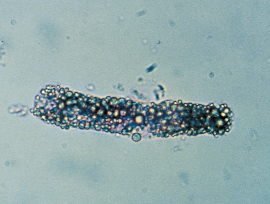 <p>Highly refractile cast matrix that contains fat droplets and oval fat bodies</p>