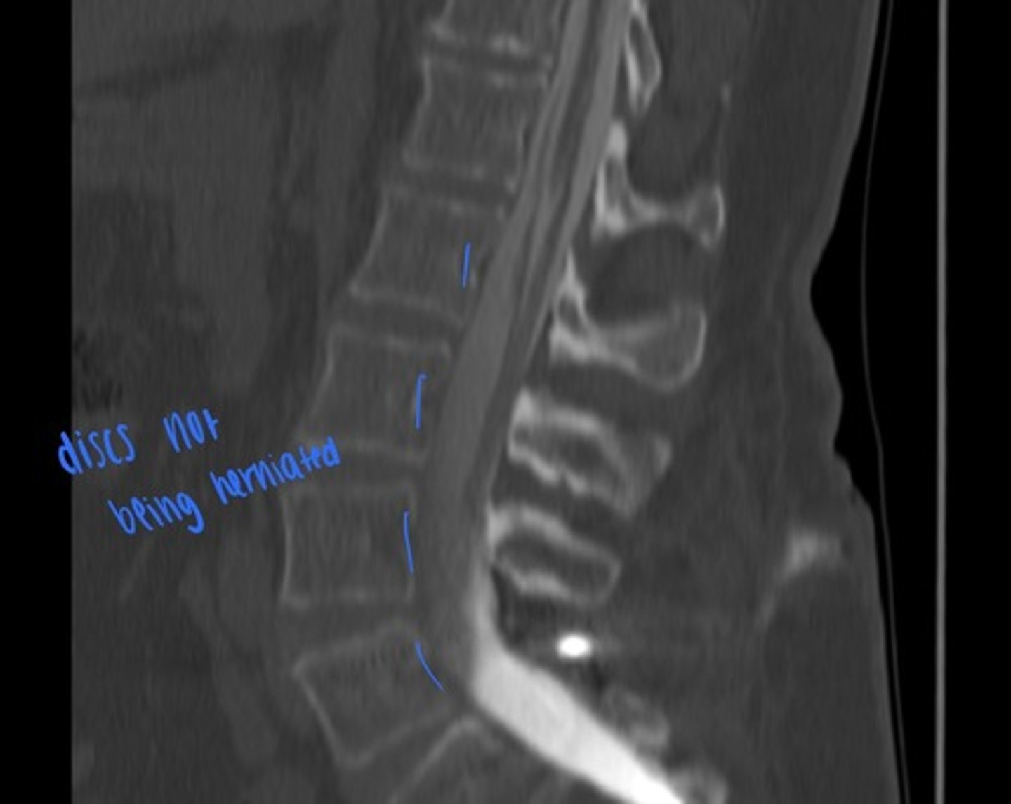 <p>what is this image?</p><p>post myelogram, contrast present</p>