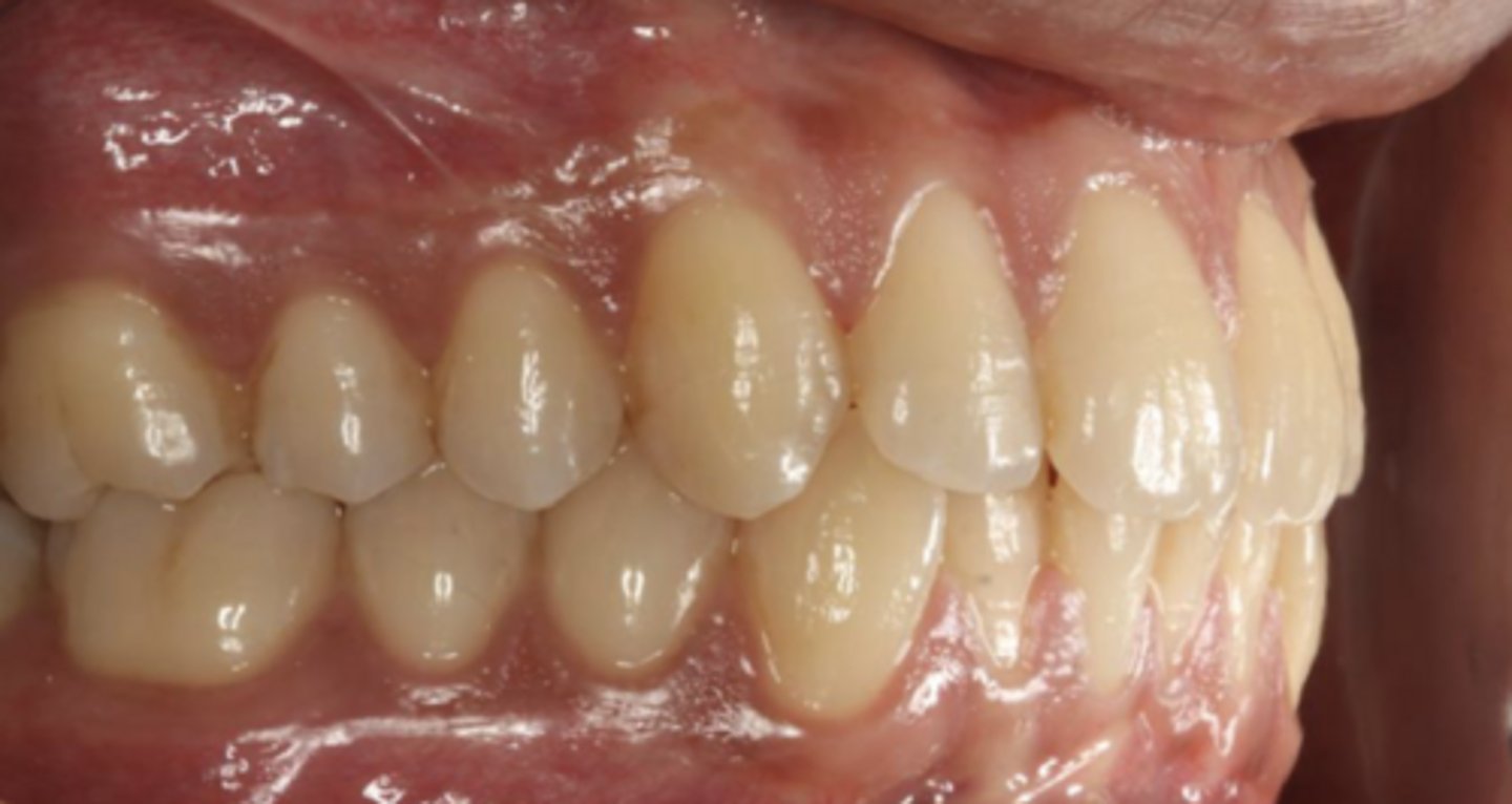 <p>Class I occlusion</p>