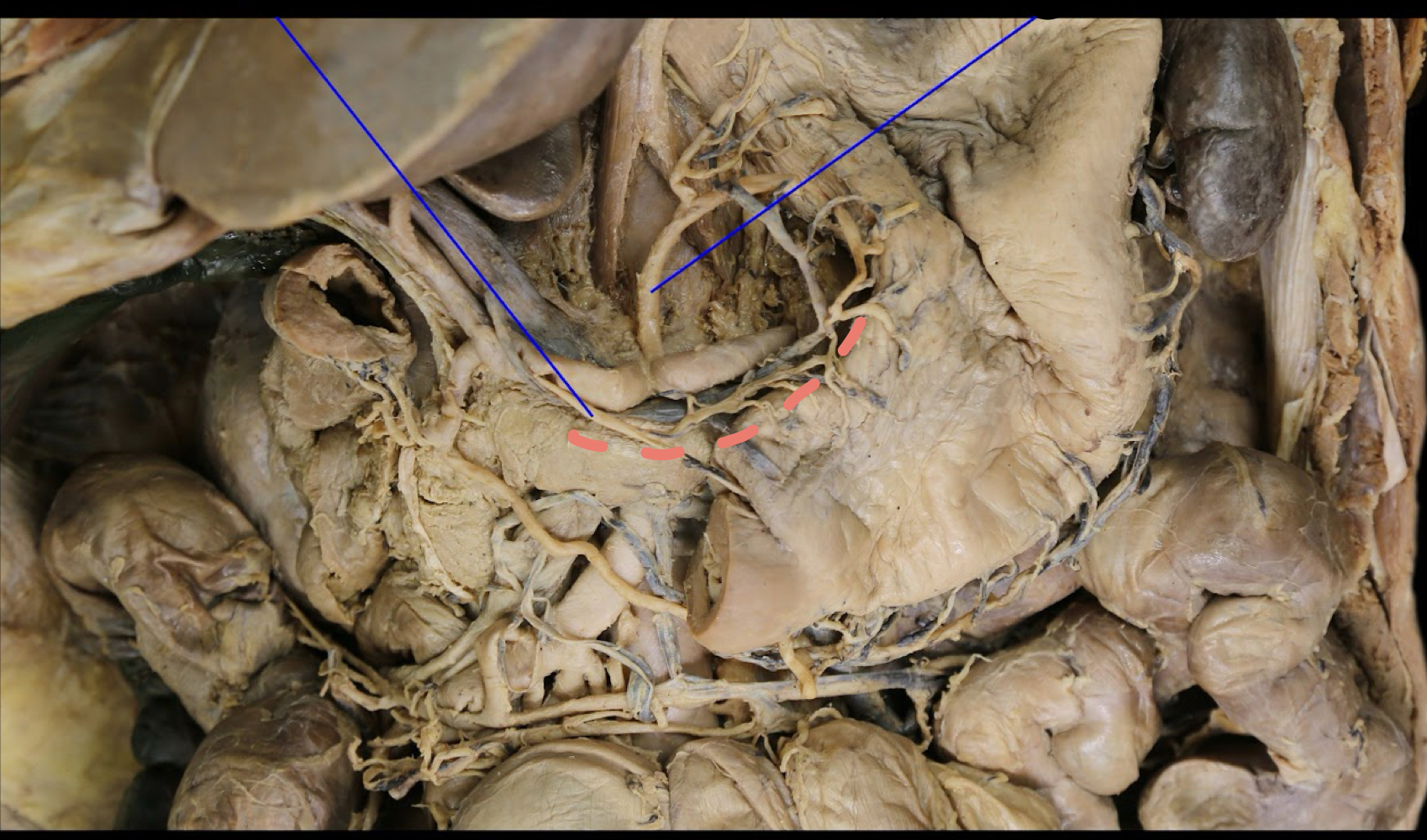 <p>A). Identify this structure<br>B). What vessels anastomose at this structure?</p>