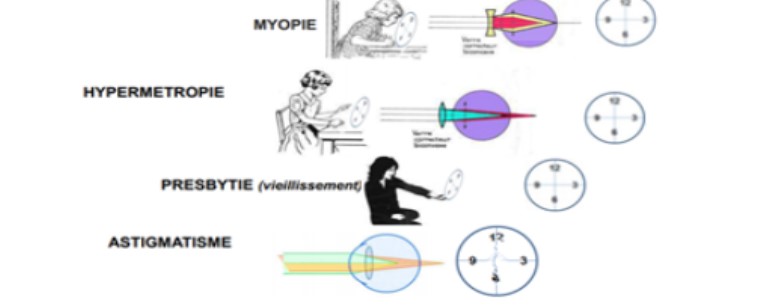 forme de l'oeil joue un rôle sur la focalisation : 
→ oeil trop long avec focalisation de l'oeil en avant de la rétine = myopie 
→ oeil trop court avec focalisation de l'oeil en arrière de la rétine = hypermétropie 