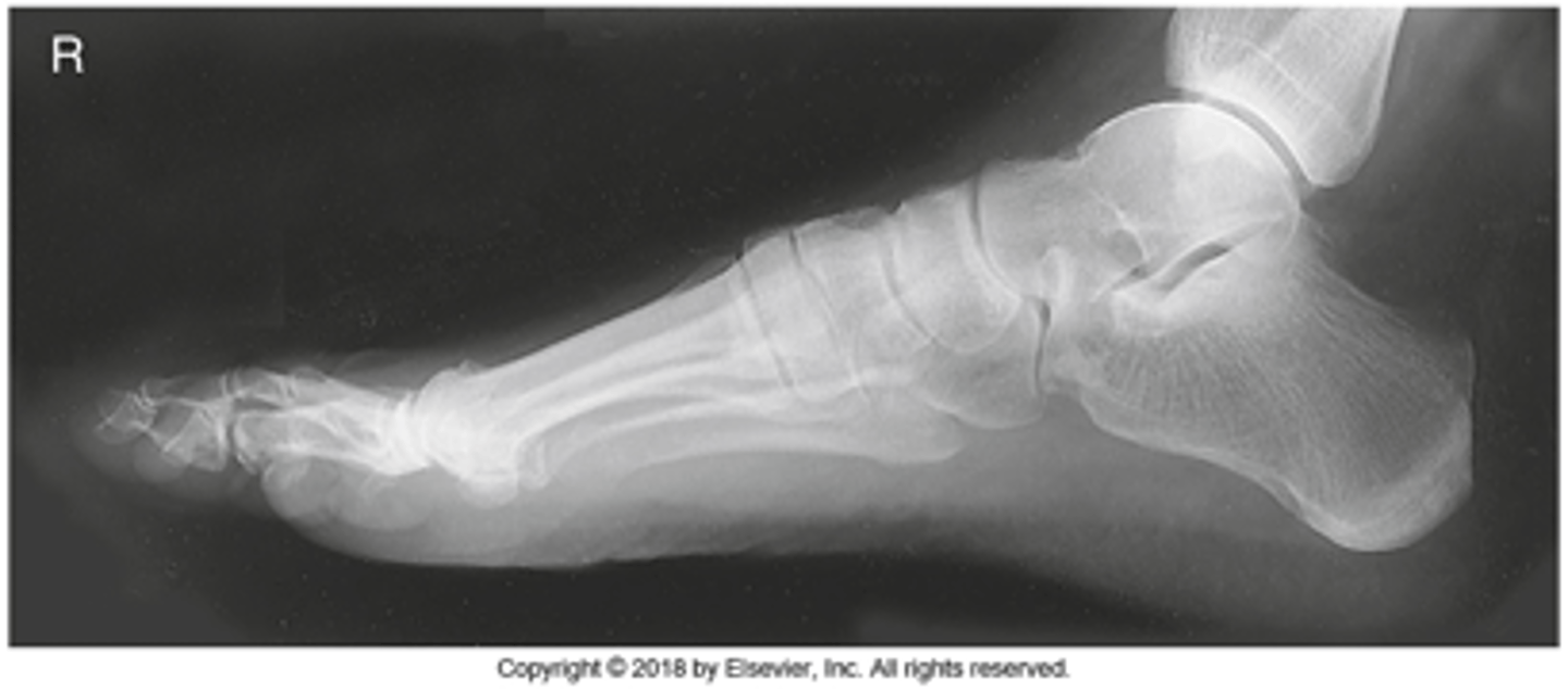 <p>- True lateral</p><p>- CR to midcuneiform (base of third MT)</p><p>- Entire foot visualized</p><p>- Tibiotalar joint demonstrated</p><p>- Metatarsals superimposed</p><p>- Optimal exposure factors</p>