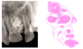 <p>- Twice as common as a complex odontome</p><p>- Maxilla > Mandible</p><p>- Incisor/Canine Regions</p><p>- Small and Non-Aggressive</p><p>- A collection of Denticles (Little Teeth)</p>