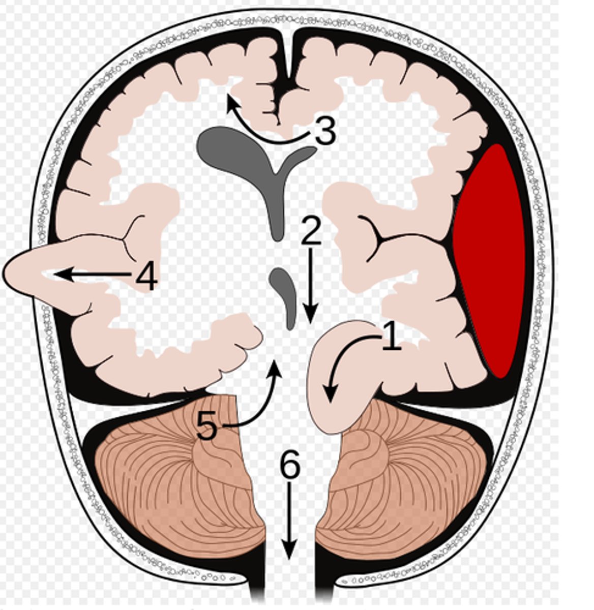 <p>shift of brain tissue from one hemisphere to the other. Compress anterior cerebral artery.</p><p>Ischemic stroke may occur</p>