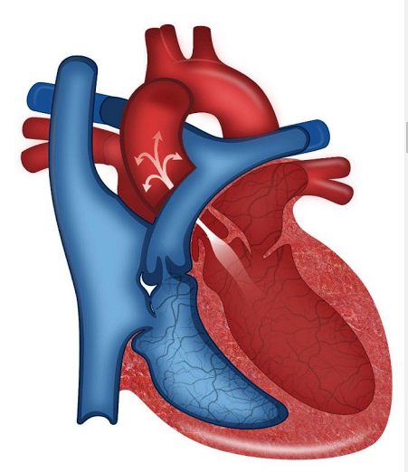 __**● Defect:**__  

○ Narrowing of the aorta  

○ Harder for the left ventricle to eject blood  

__**● History:**__  

○ Activity intolerance, fatigue, chest pain  

○ Sudden death due to ventricular arrhythmias  

__**● Specific assessment findings:**__  

○ Exercise intolerance and syncopal episodes  

○ Narrow pulse pressure 

○ Pronounced apical impulse ○ Thrill 

__**● Treatment**__  

○ Critical  

■ Balloon valvuloplasty asap! Prevent shock!  

○ Ross procedure  

○ Surgical valve replacement. If mechanical valve - will need anticoagulated! 

○ Severe: needs to avoid contact sports.  
