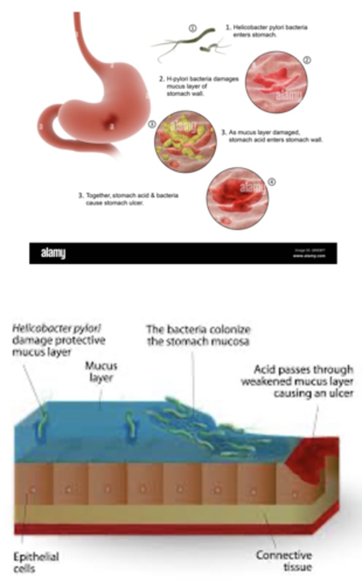 <p>How does a combination of H. pylori infection and NSAIDs affect the risk of gastroduodenal ulcer and ulcer bleeding?</p>