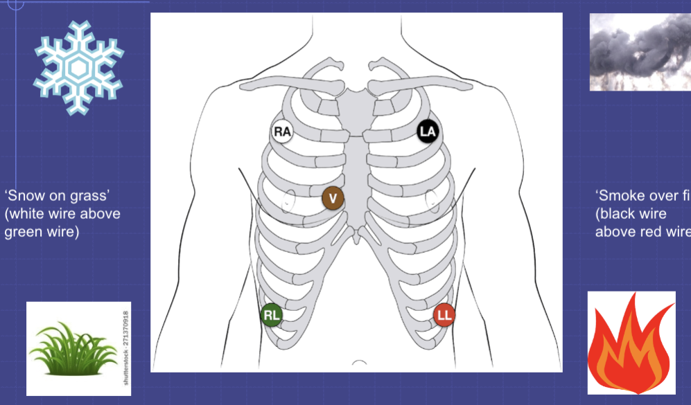 <p>it is the placement of the electrodes for a 5-lead monitor </p><ol><li><p>white at the second right intercostal space</p></li><li><p>black at the second left intercostal space</p></li><li><p>green at the eighth right intercostal space</p></li><li><p>red at the eighth left intercostal space</p></li><li><p>brown at the fourth intercostal space on the right sternal border </p></li></ol><p></p>