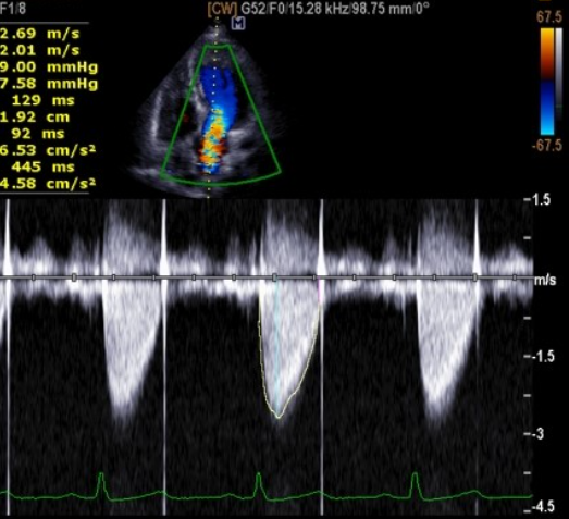 <p>Identify the spectral Doppler waveform:</p>