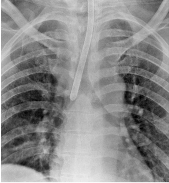 <p><span>lung collapse of the contralateral side</span></p>