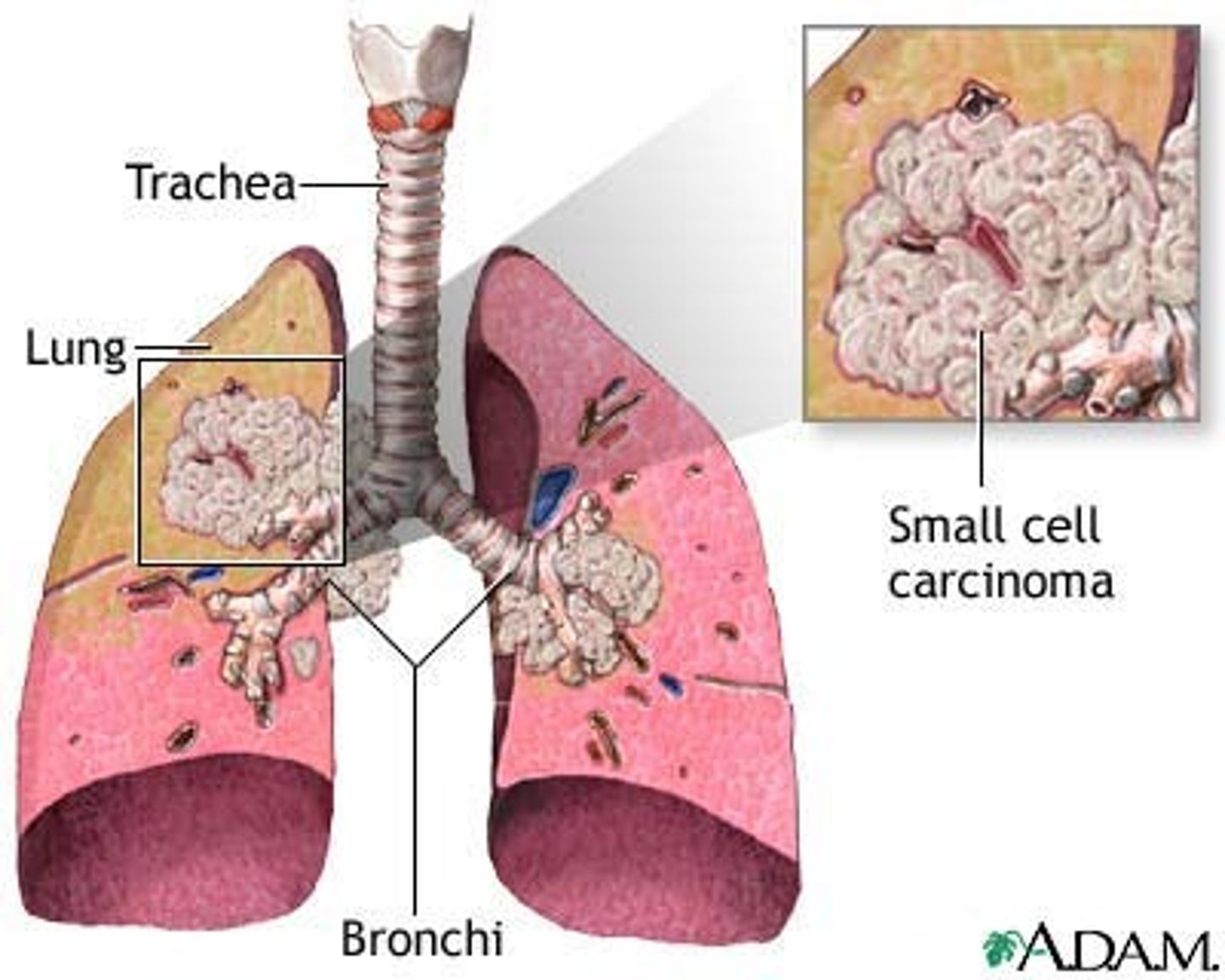 <p>malignant tumor arising from the lungs and bronchi</p>