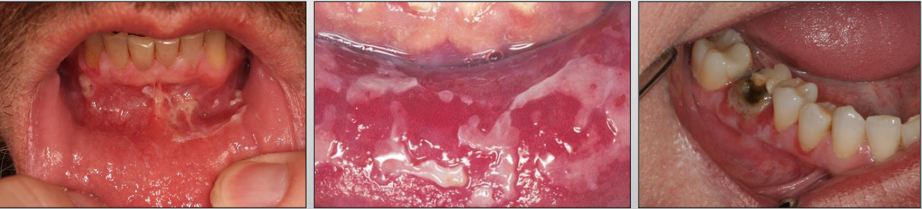 <p>A severe, progressive autoimmune disease that affects both the <strong>skin and mucous membranes</strong></p>