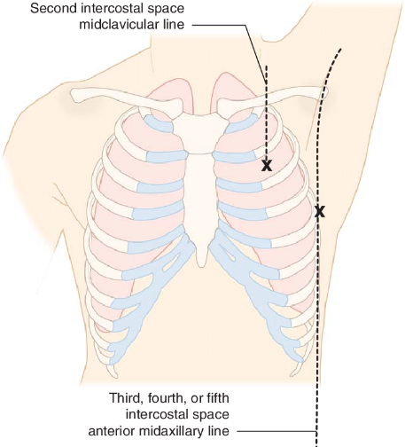 <ul><li><p>Adults: 4th or 5th intercostal space at the mid-axillary line (a line from the middle of the armpit). Same location as chest drain insertion.</p></li><li><p>Children: 2nd intercostal space (below 2nd rib), in line with the middle of the clavicle.</p></li></ul>
