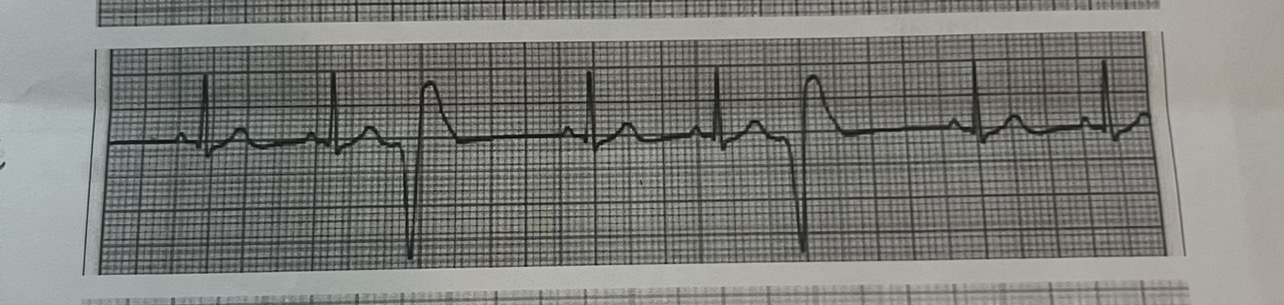 <p>Premature ventricular contractions (PVCs)</p>