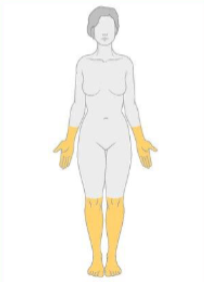 <p>what type of neuropathy would have the following distribution?&nbsp;</p>