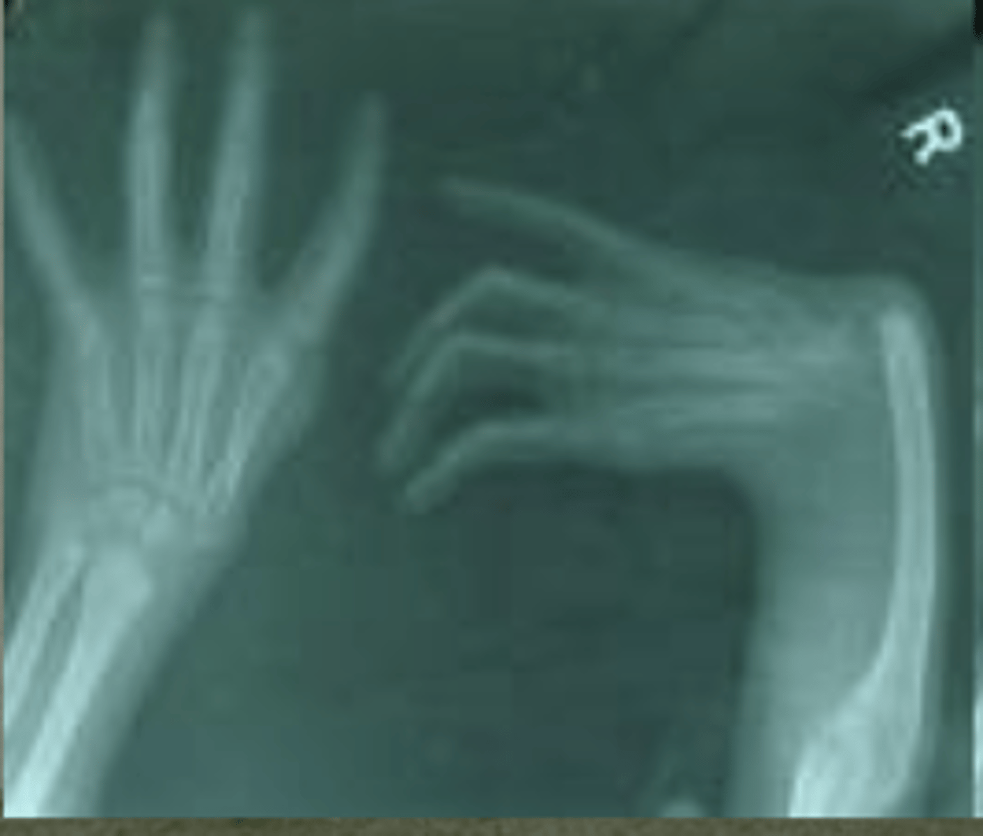 <p>Fanconi anemia</p>