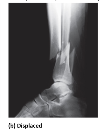 <p>fracture with shifted fragments </p><ul><li><p>bone needs to be set before healing</p></li></ul><p></p>