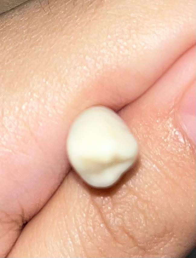 <p>What tooth is this (with view)?</p>