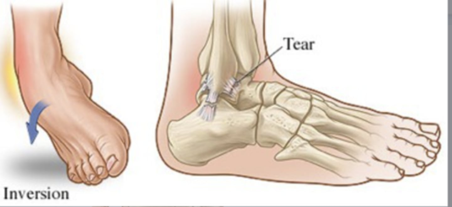 <p>inversion injury (90%)!</p>