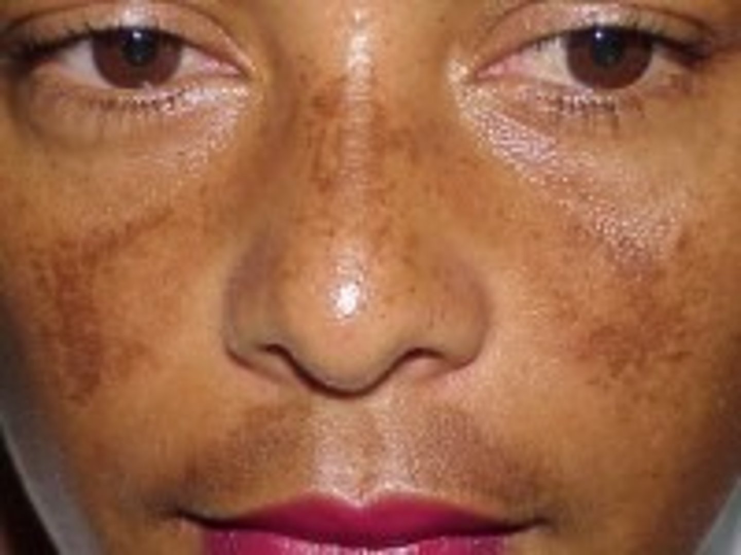 <p>diagnose this image:</p><p>Skin hyperpigmentation, seen in women on facial skin (malar region, upper lip, and/or forehead)</p>