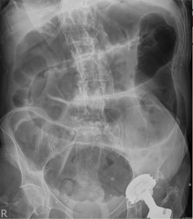 <p>Identify the type of bowel obstruction</p>