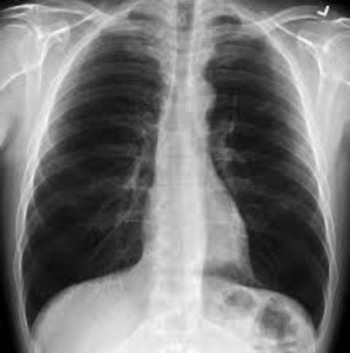 <p>A 37-year-old male presents to the clinic after returning home from travels in Bangladesh. He had</p><p>been working in the homeless shelter and is now concerned after having learned about a rampant</p><p>tuberculosis outbreak there. He is asymptomatic but is still concerned he might have contracted TB.</p><p>You obtain a chest x-ray and a CBC. The bloodwork is normal. The chest x-ray is as below. Which of</p><p>the following is true?</p>