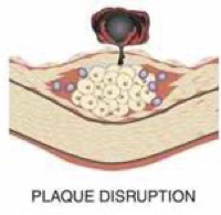 <p>plaque disruption; intracoronary thrombus </p>