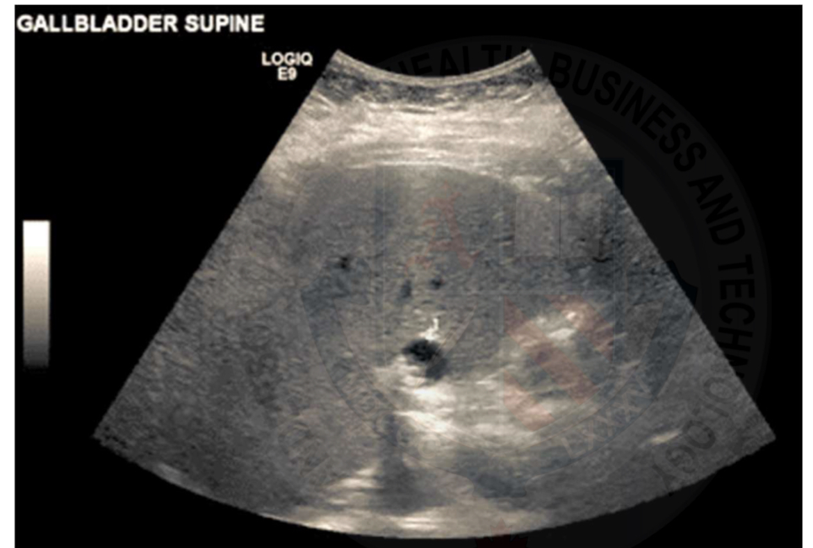 <p>Rare </p><p>Asymptomatic </p><p>Jaundice may be present with a dilated common bile duct </p><p>High incidence of choledocholithiasis </p>