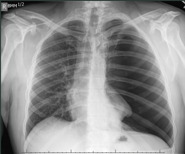 <p>What pathology is seen on this x-ray?</p>