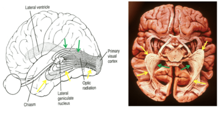 <p><strong>Visual pathway (optic radiations)</strong></p><p>(Fibers run from thalamus (lateral geniculate nucleus - LGN) carrying axons of visual pathway caudally to primary visual cortex along calcarine sulcus)</p>