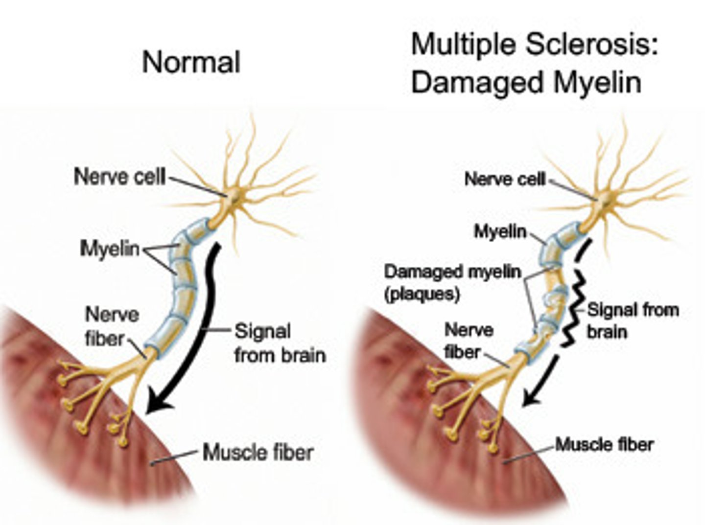 <p>a progressive disease in which the protective covering of the nerves, spinal cord, and white matter of the brain breaks down over time; without this covering, nerves cannot send clear messages to and from the brain in a normal way</p>