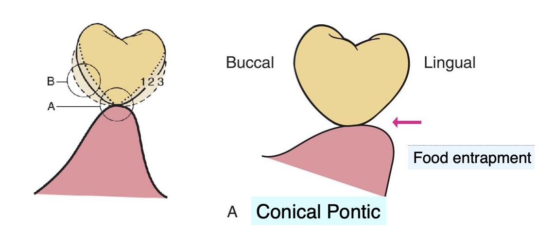 <p>unsuitable for broad residual ridges (bc the emergence profile associated w the small tissue contact point may create areas of food entrapment)</p>