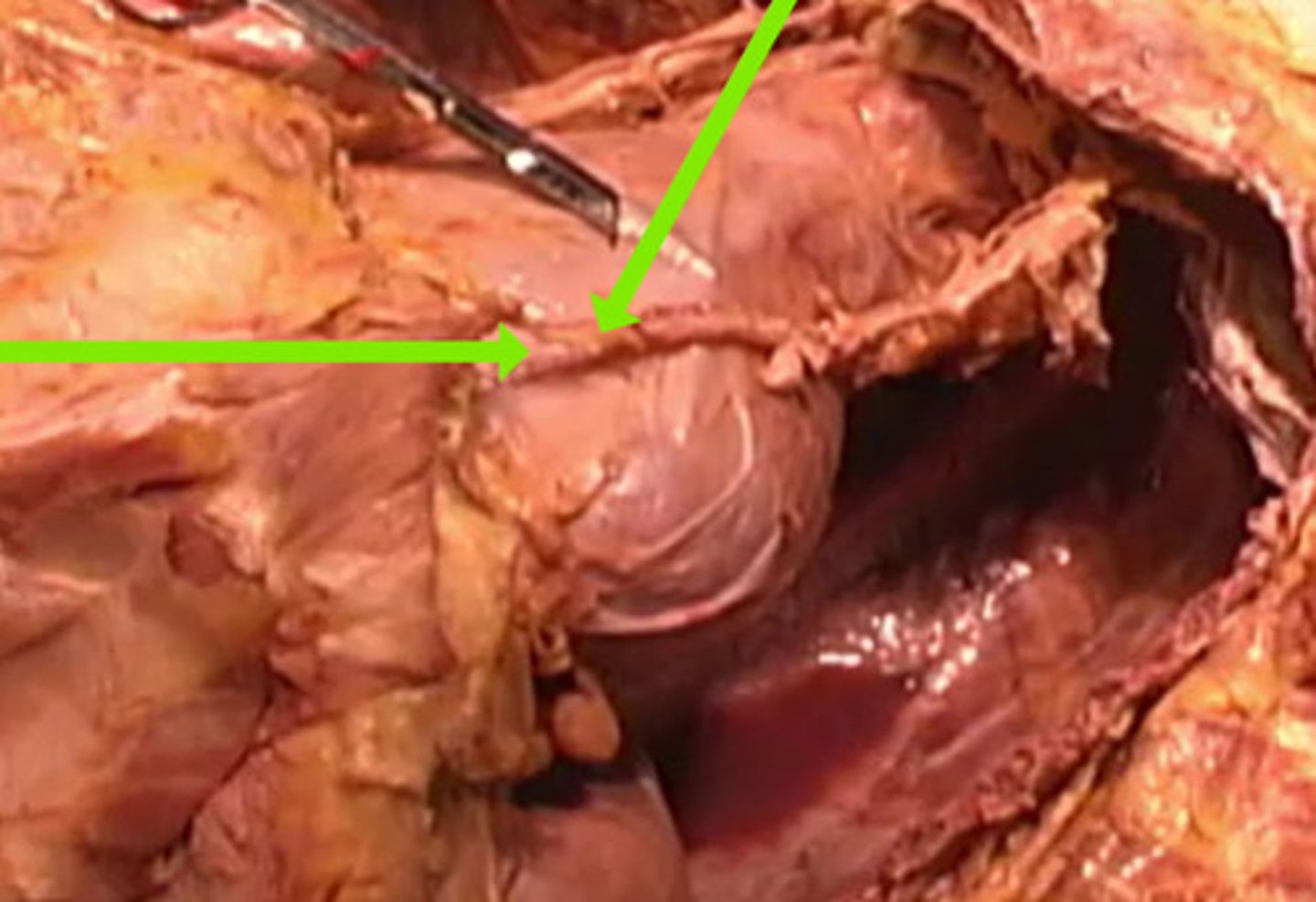 <p>To what structure is the arrow pointing?</p><p>internal thoracic artery</p><p>pericardial sac</p><p>internal medial artery</p><p>aorta</p>